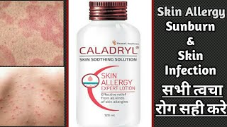 Caladryl Skin Soothing Lotion Review  Skin allergy infection itching amp Sunburn medicine [upl. by Larok]