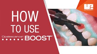 How to Use Opalescence™ Boost™ Professional Teeth Whitening  StepbyStep Procedure [upl. by Ynnor]