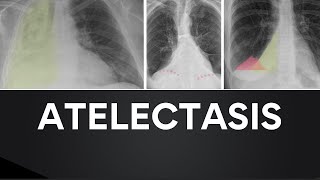 Atelectasis Chest Xrays with Overlays [upl. by Ennasus]