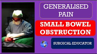 SMALL BOWEL OBSTRUCTION How To DIAGNOSE amp TREAT  GENERALISED ABDOMINAL PAIN [upl. by Renie]