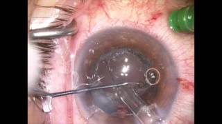 Repair of capsular bag dialysis IOL decentration and pars plana vitrectomy by Steven G Safran MD [upl. by Markman]