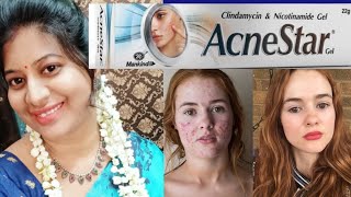 Acne Star Gel amp Acne Star soap Review in telugu HOW TO GET RID OF ACNE FAST [upl. by Harbison185]