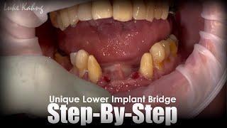 Unique Lower Implant Bridge [upl. by Seaman931]