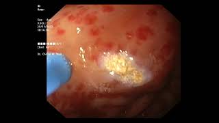 GASTRIC ANTRAL VASCULAR ECTASIA WITH APC ABLATION [upl. by Htbazile]