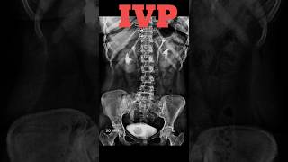 IVP  Intravenous pyelography shorts ivp specialcase radiology radiologyjunction [upl. by Rhianon]