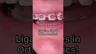 Types of ligation with Braces  Tooth Time Family Dentistry New Braunfels Texas [upl. by Weisburgh358]