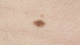 Melanoma symptoms How to spot signs and when to see a doctor [upl. by Jennings]