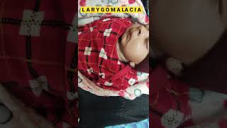 Laryngomalacia laryngomalacia noisy breathing chest [upl. by Aneral]