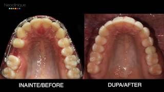 Aparat Dentar Neoclinique [upl. by Noitsuj240]