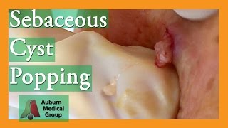 Epidermoid Cyst Popping popping  Auburn Medical Group [upl. by Emory309]