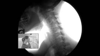 Video Fluoroscopy of my neck [upl. by Notsecnirp]