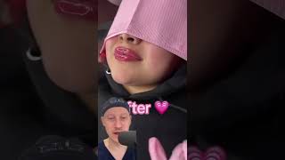 SHOCKING Before And After Lips Overfilled with Hyaluronic Acid  Plastic Surgeon Reacts [upl. by Seltzer]