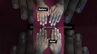 Vitiligo ￼patients Correction tattoo❤️h2otattoo vitiligoawareness trending viral tattoo tamil [upl. by Aym]