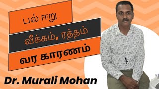 பல் ஈறு வீக்கம் ரத்தம் வர காரணம்  Gum swelling bleeding for reason [upl. by Trueman]