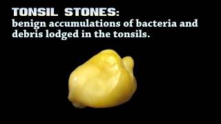 What Are Tonsil Stones Popping Stones [upl. by Aekerly]