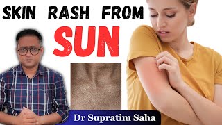 धूप से एलर्जी  PMLE  Most common skin rash from sun exposure  Hindi  Dr Supratim Saha [upl. by Shanon]