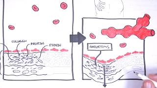 Polyarteritis Nodosa and Kawasaki Disease Medium Vessel Vasculitis  Symptoms pathophysiology [upl. by Rusel]