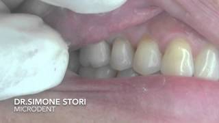 Dente affetto da Parodontite Severa Curato con Laser [upl. by Nehpets]