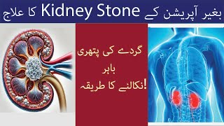 Kideny Stones ko Kaise Nikala Jae  How to Remove Kidney Stones  Removal Of Kidney Stones [upl. by Mullins]