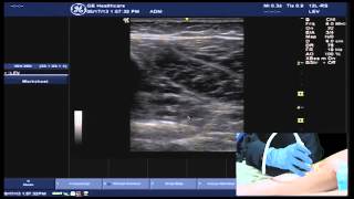 Hot Tips  Locating the Calf Vein with Ultrasound [upl. by Suhcnip910]