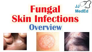 Overview of Fungal Skin Infections  Tinea Infections [upl. by Haissem]