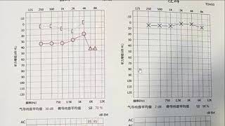 16DB after Atresia repair surgery [upl. by Kinemod432]