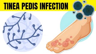 Tinea Pedis Infection Athletes Foot  Causes Types Signs amp Symptoms And Treatment [upl. by Samuela]