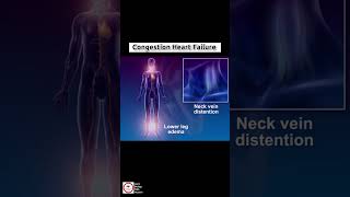 Congestive Heart Failure CHF  cardiology [upl. by Ewolram287]