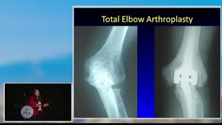 orthoPAc podcast episode 204  Elbow Arthritis and Arthroplasty Part 1 [upl. by Peterus]