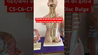 Cervical Problem amp Lower Back Pain Treatment shorts sciatica neckpain [upl. by Eimas534]