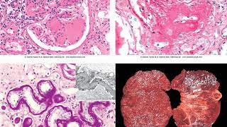 Pathology of the endocrine pancreas 1 [upl. by Anait]