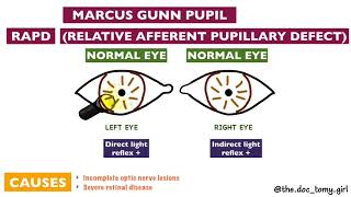 Abnormal Pupillary Reflexes  Ophthalmology [upl. by Zoarah15]