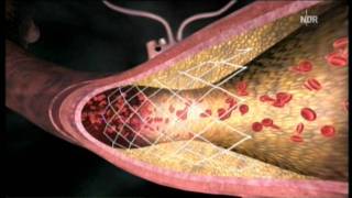 Arteriosklerose  Stent oder Bypass [upl. by Crofoot926]