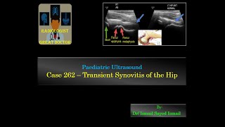 Ultrasound Case 262  Transient Synovitis of The Hip [upl. by Fondea]