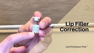 Lip Filler Correction [upl. by Libbi371]