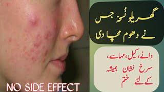 How to remove pimples in urdu  Dano ki cream  Pimple  Pimples on face treatment at home [upl. by Sexela]