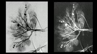 Arteriografia renal seletiva [upl. by Oderfodog]