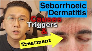 Seborrhoeic Dermatitis  Causes Triggers amp Treatment Options [upl. by Cia]