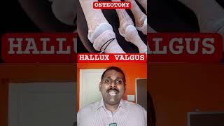 HALLUX VALGUS procedure [upl. by Marentic826]