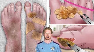 ASMR Animation Help Kevin De Bruyne treat calluses feet [upl. by Phila]