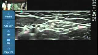 Ultrasound location of medial cutaneous nerve of forearm [upl. by Reinert]