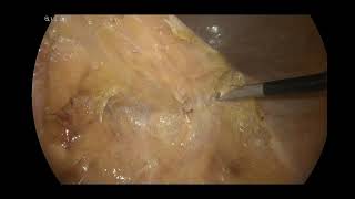 Laparoscopic left colectomy for sigmoid adenocarcinoma [upl. by Eened]