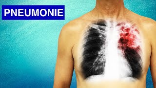 Pneumonie  Symptômes Diagnostic et Traitements [upl. by Howes]