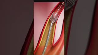 एंजियोप्लास्टी में स्टेंट कैसे लगाते है Angioplasty Stent Insertion Tutorial  StepbyStep Guide [upl. by Didi]