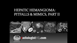 Hepatic Hemangioma Pitfalls amp Mimics Part II [upl. by Easton]