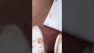 Big Cystic Acne Blackheads Extraction Blackheads amp Milia Whiteheads Removal Pimple Popping shorts [upl. by Tigdirb]