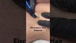 Electrolysis Hair Removal [upl. by Ahsiela560]