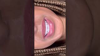 Porcelain Veneers in Dubai  Dr Nazima Yakubova dentist veneers cosmeticdentistry [upl. by Anih]