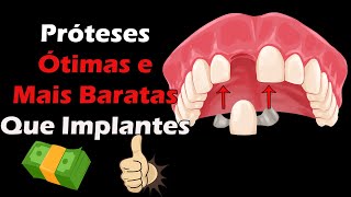 Prótese Fixa e Adesiva  Ótimas Opções Para Substituir Dentes Perdidos Além do Implante Dentario [upl. by Calypso]