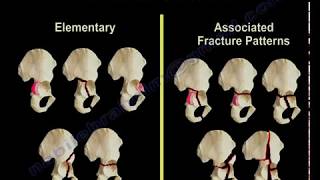 Acetabulum Fracture Types  Everything You Need To Know  Dr Nabil Ebraheim [upl. by Ydok]